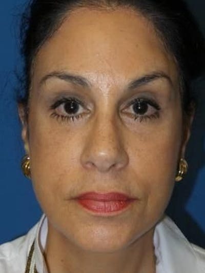 Brow Lift Before & After Gallery - Patient 271559 - Image 2