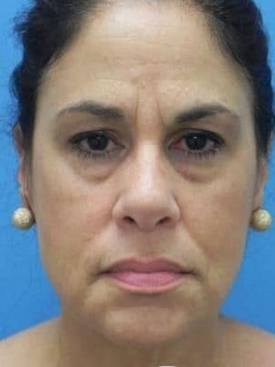 Brow Lift Before & After Gallery - Patient 271559 - Image 1