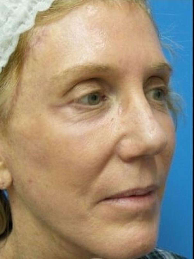 Brow Lift Before & After Gallery - Patient 384845 - Image 6
