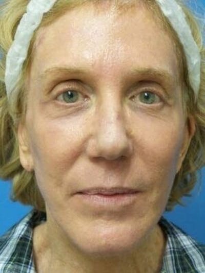 Brow Lift Before & After Gallery - Patient 384845 - Image 2