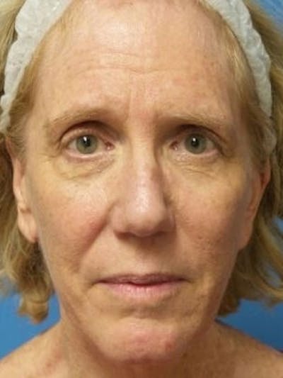Brow Lift Before & After Gallery - Patient 384845 - Image 1
