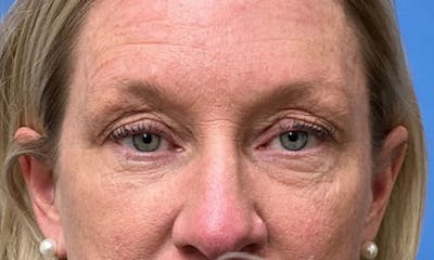 Eyelid Surgery Before & After Gallery - Patient 153332 - Image 1
