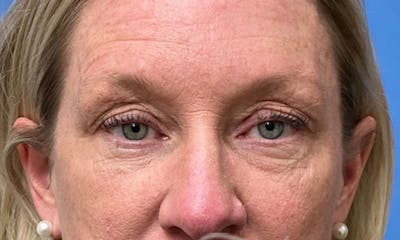 Eyelid Surgery Before & After Gallery - Patient 153332 - Image 1