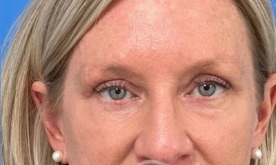 Eyelid Surgery Before & After Gallery - Patient 153332 - Image 2