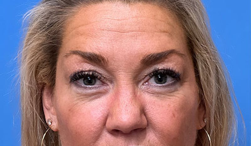 Eyelid Surgery Before & After Gallery - Patient 339546 - Image 1