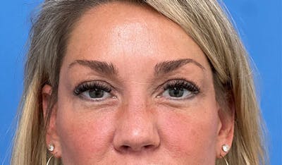 Facelift Before & After Gallery - Patient 328536 - Image 2