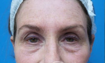Eyelid Surgery Before & After Gallery - Patient 262618 - Image 1