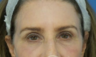 Eyelid Surgery Before & After Gallery - Patient 262618 - Image 2