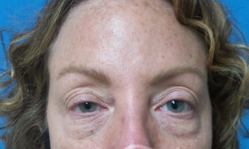Eyelid Surgery Before & After Gallery - Patient 268181 - Image 1