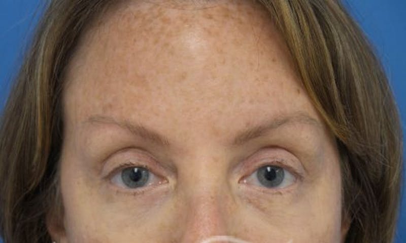 Eyelid Surgery Before & After Gallery - Patient 268181 - Image 2