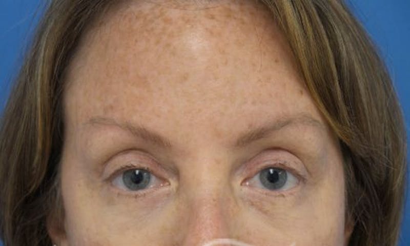 Eyelid Surgery Before & After Gallery - Patient 268181 - Image 2