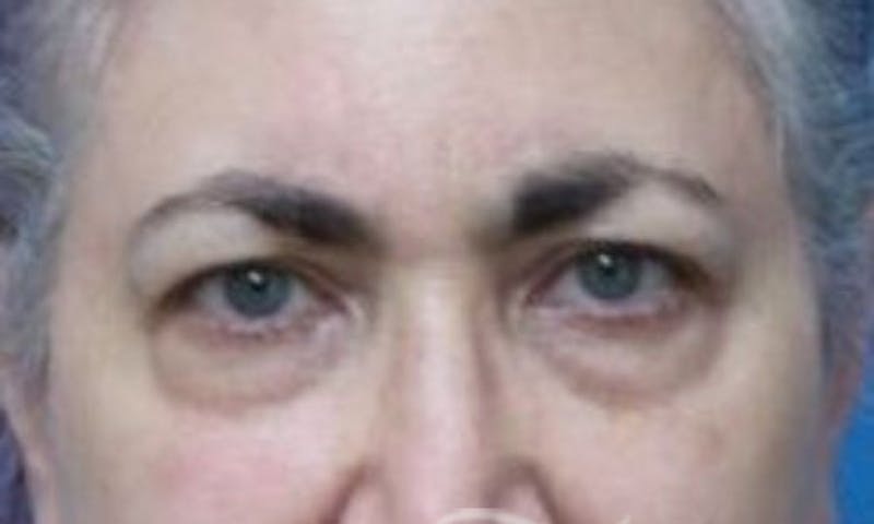 Eyelid Surgery Before & After Gallery - Patient 371098 - Image 1