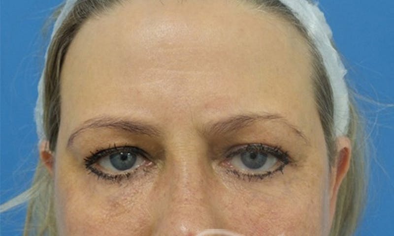 Eyelid Surgery Before & After Gallery - Patient 186182 - Image 2