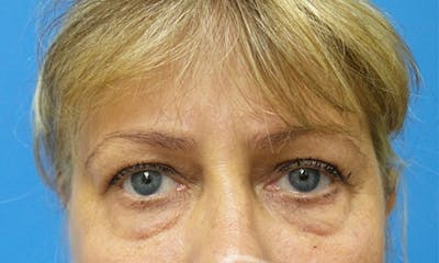 Eyelid Surgery Before & After Gallery - Patient 186182 - Image 1