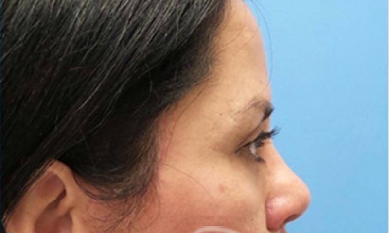 Eyelid Surgery Before & After Gallery - Patient 374607 - Image 4