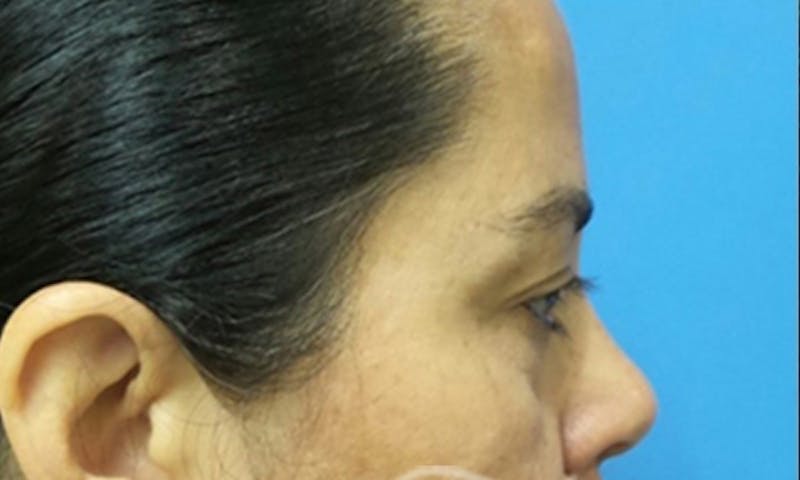 Eyelid Surgery Before & After Gallery - Patient 374607 - Image 3