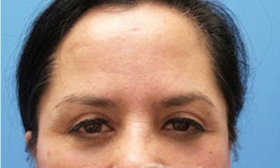 Eyelid Surgery Before & After Gallery - Patient 374607 - Image 2