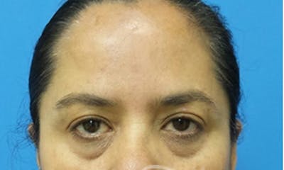 Eyelid Surgery Before & After Gallery - Patient 374607 - Image 1