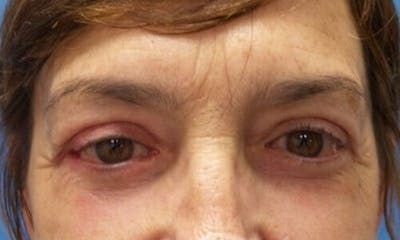 Eyelid Surgery Before & After Gallery - Patient 280579 - Image 2