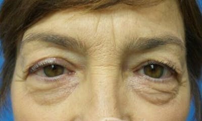 Eyelid Surgery Before & After Gallery - Patient 280579 - Image 1