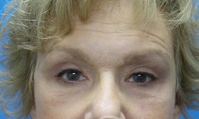 Eyelid Surgery Before & After Gallery - Patient 122858 - Image 2