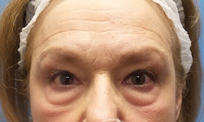 Eyelid Surgery Before & After Gallery - Patient 122858 - Image 1
