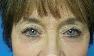 Eyelid Surgery Before & After Gallery - Patient 427005 - Image 2