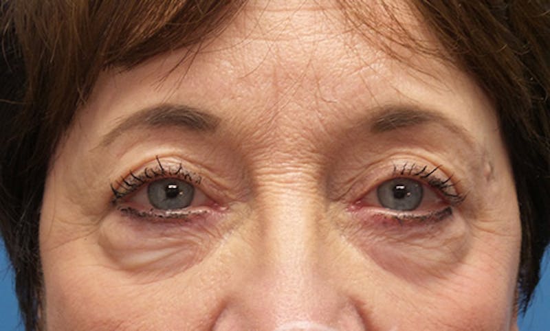 Eyelid Surgery Before & After Gallery - Patient 427005 - Image 1