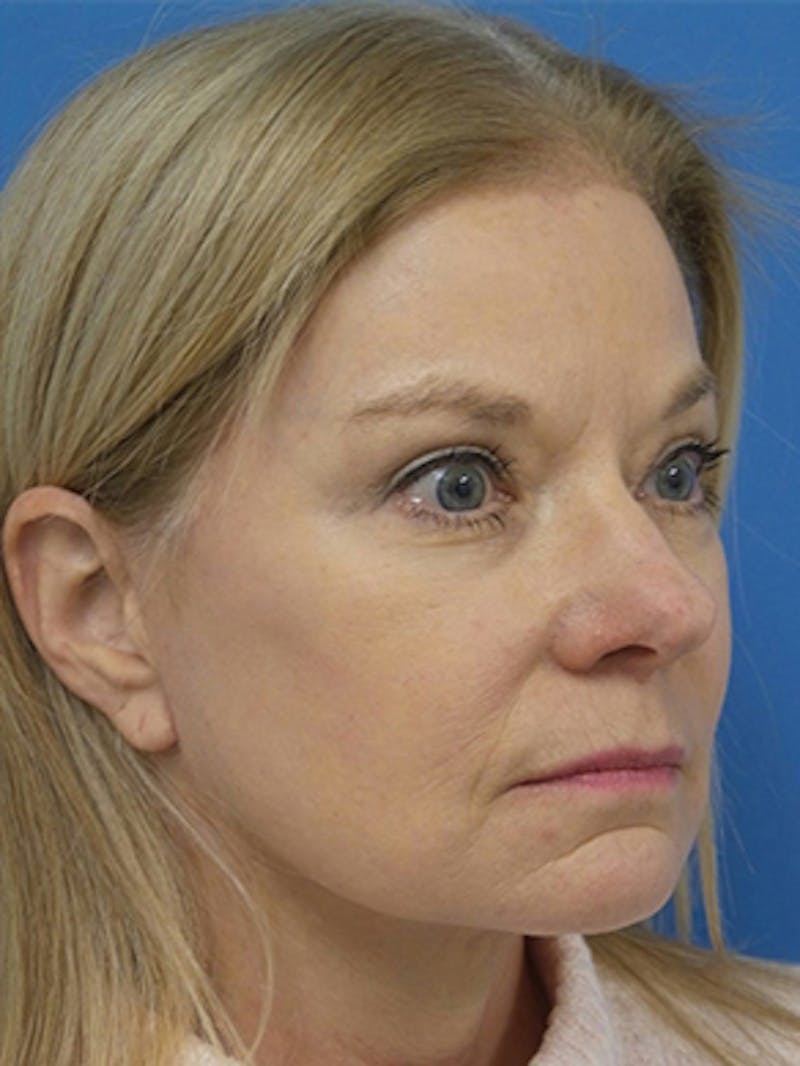 Brow Lift Before & After Gallery - Patient 684066 - Image 6
