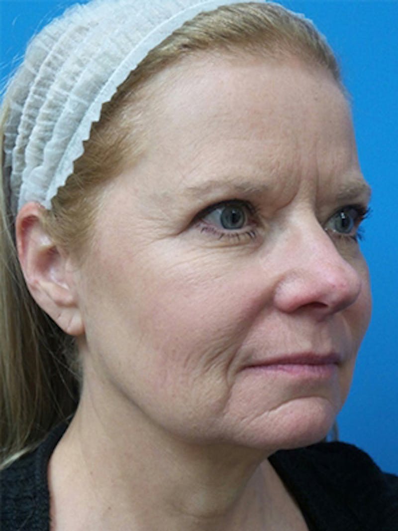 Brow Lift Before & After Gallery - Patient 684066 - Image 5
