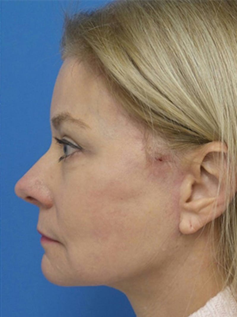 Brow Lift Before & After Gallery - Patient 684066 - Image 4