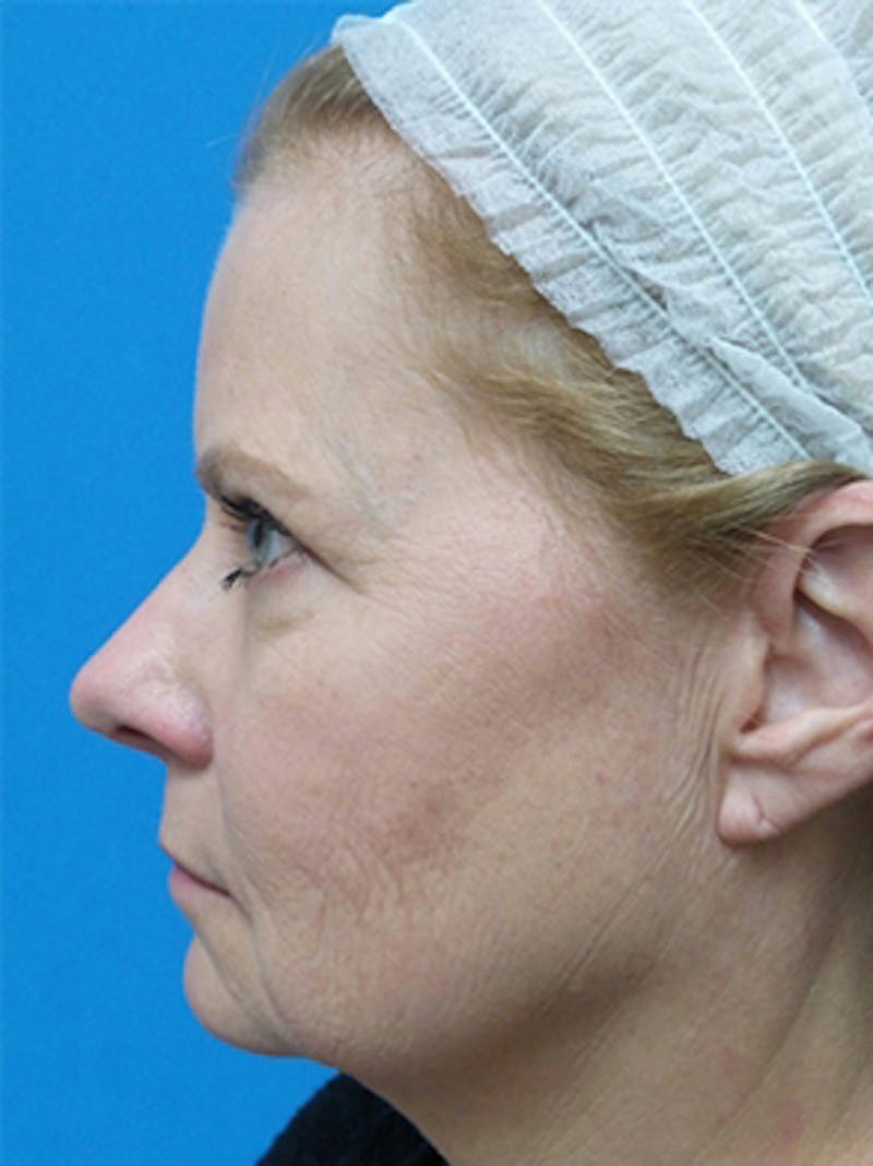 Brow Lift Before & After Gallery - Patient 684066 - Image 3