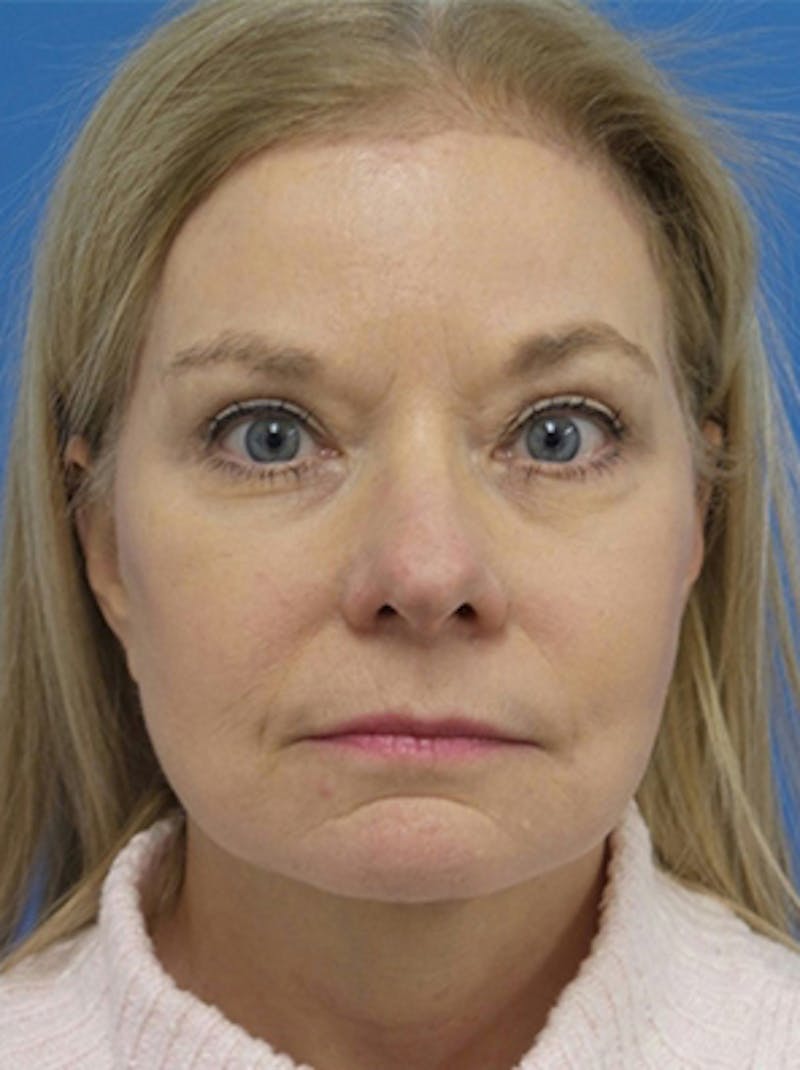 Brow Lift Before & After Gallery - Patient 684066 - Image 2