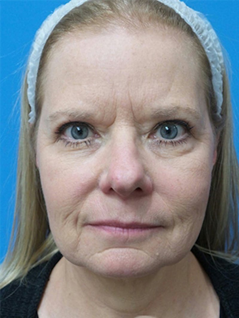 Brow Lift Before & After Gallery - Patient 684066 - Image 1