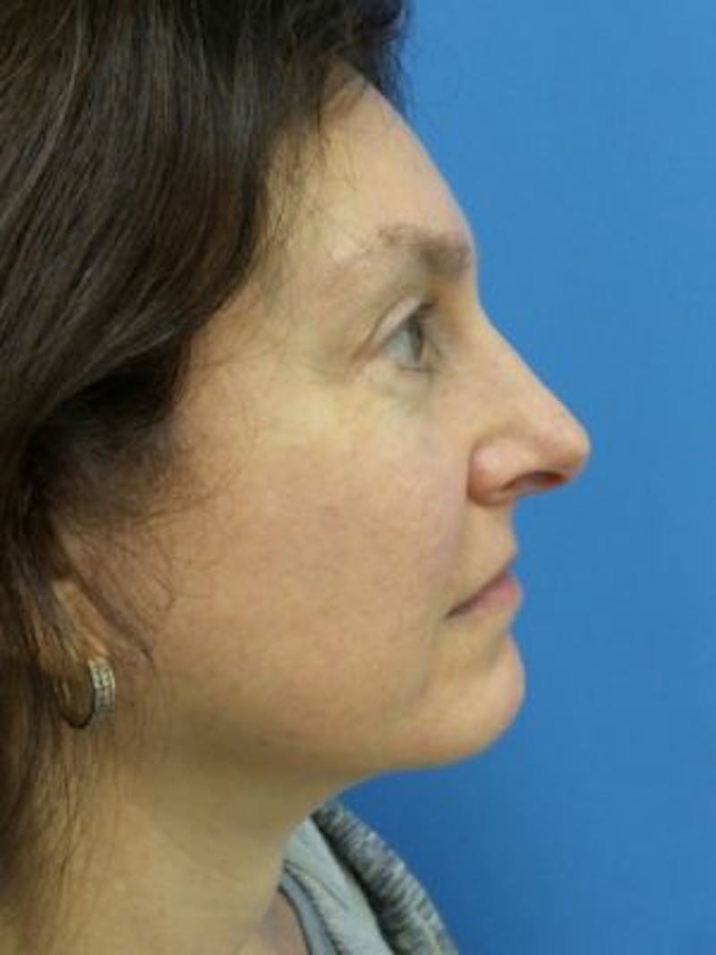 Facelift Before & After Gallery - Patient 101099 - Image 4