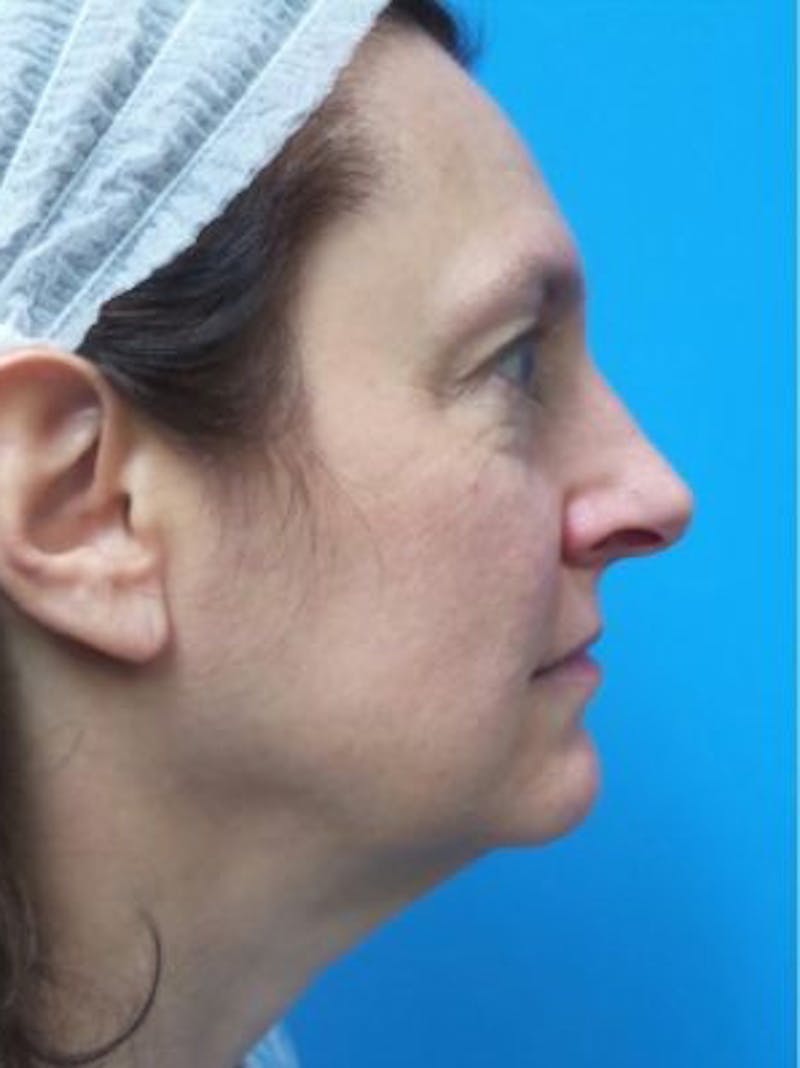 Brow Lift Before & After Gallery - Patient 266388 - Image 3