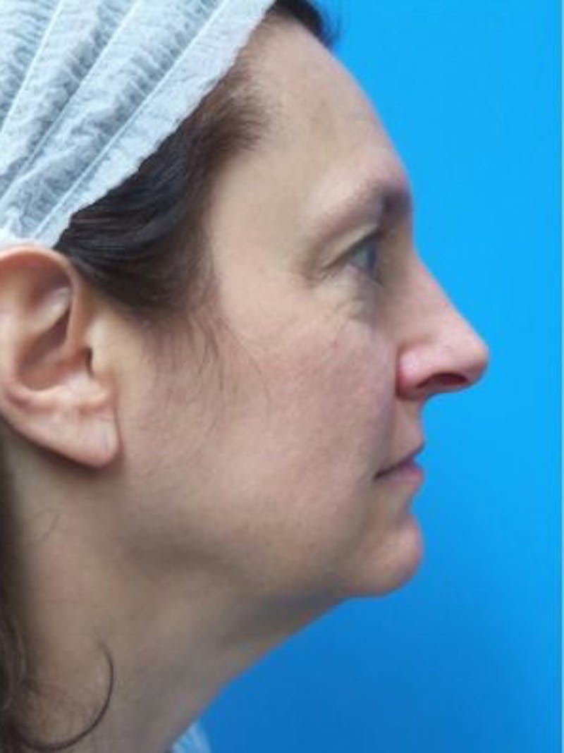 Facelift Before & After Gallery - Patient 101099 - Image 3