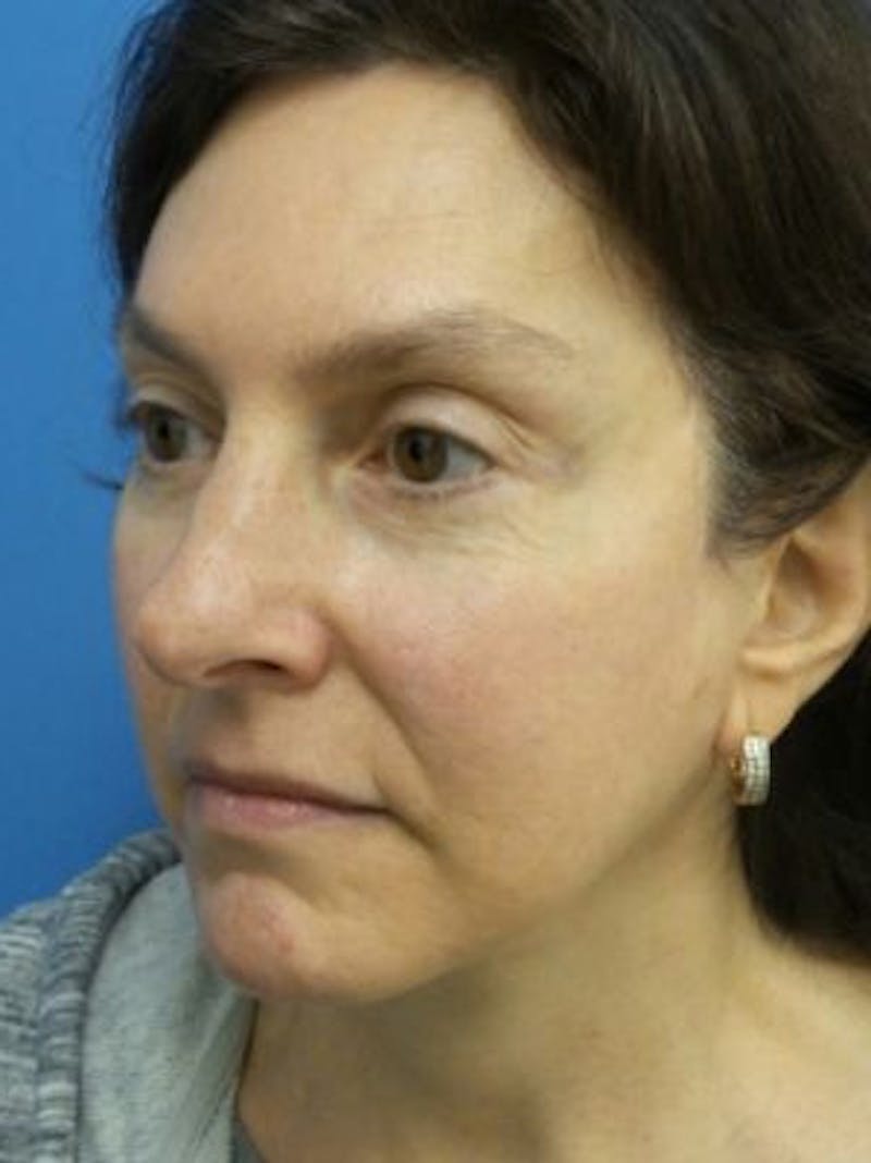 Facelift Before & After Gallery - Patient 101099 - Image 6