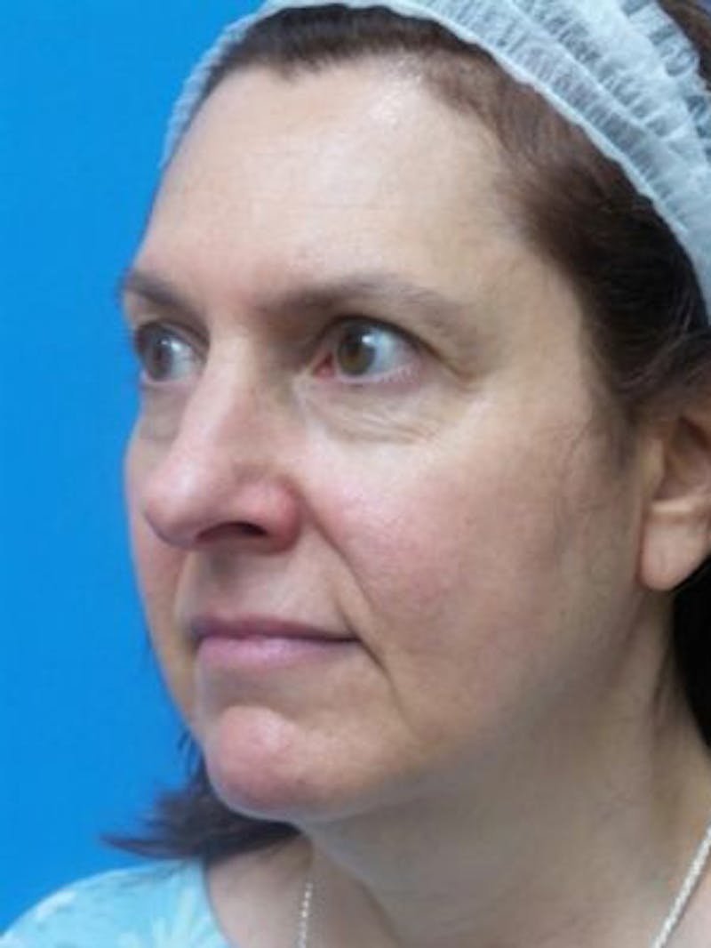 Facelift Before & After Gallery - Patient 101099 - Image 5