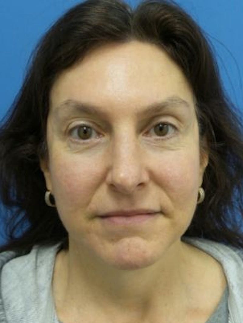 Facelift Before & After Gallery - Patient 101099 - Image 2