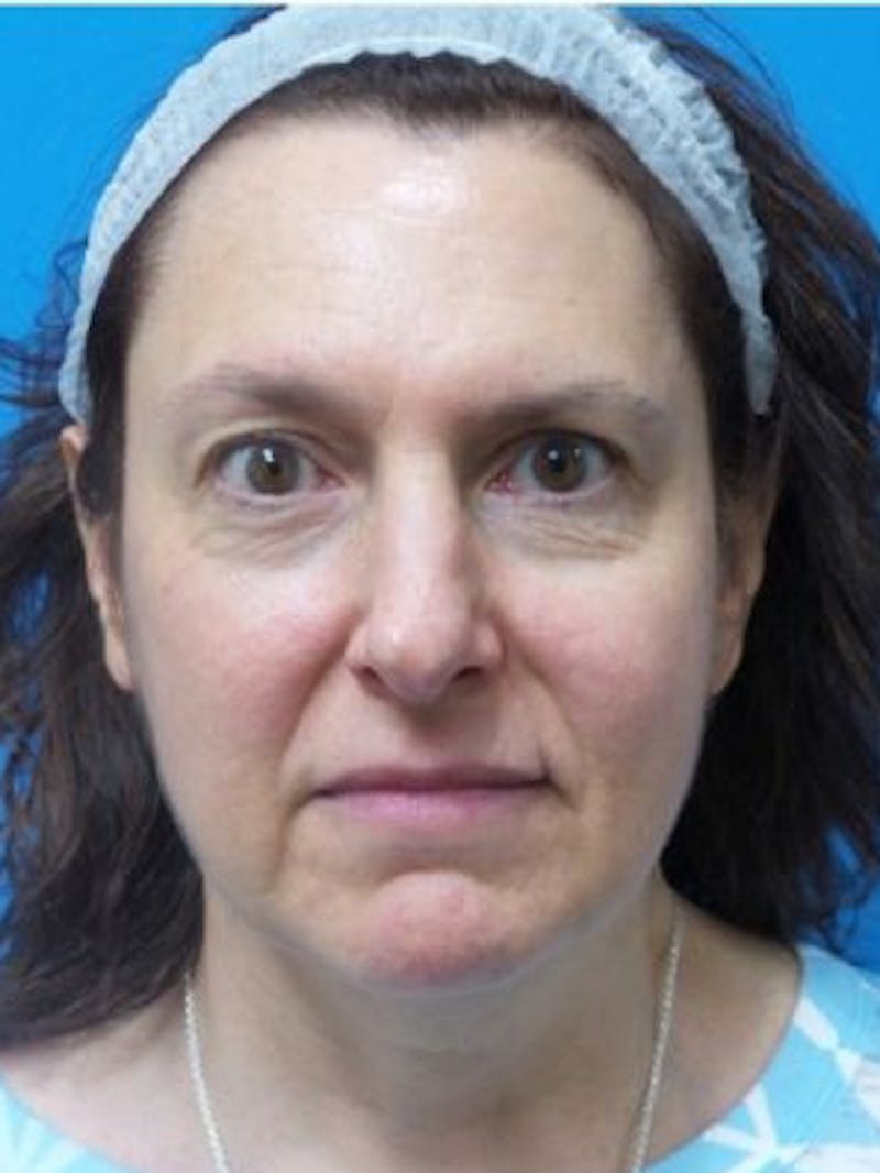 Facelift Before & After Gallery - Patient 101099 - Image 1