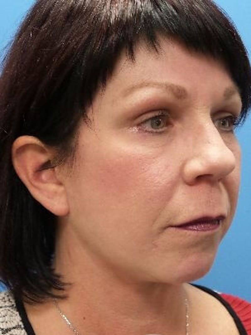 Brow Lift Before & After Gallery - Patient 312112 - Image 6