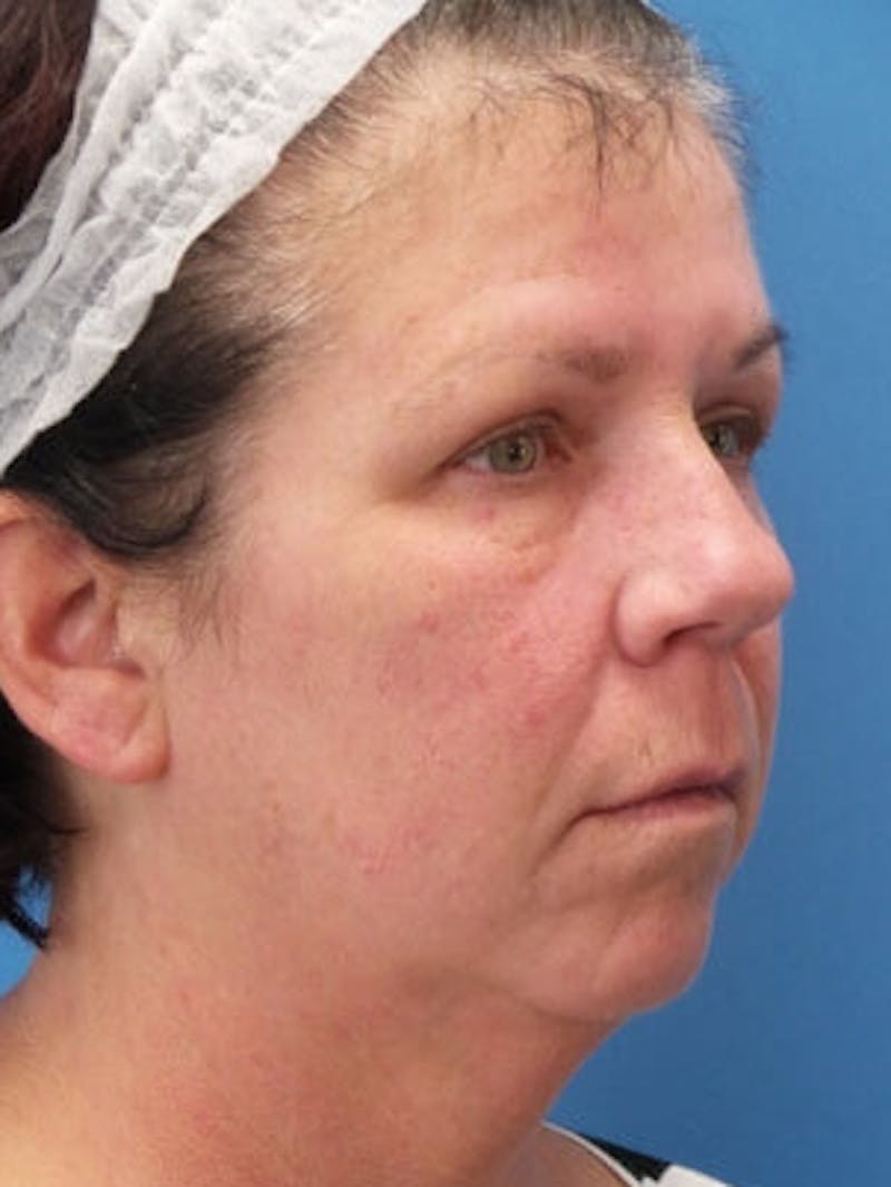 Brow Lift Before & After Gallery - Patient 312112 - Image 5