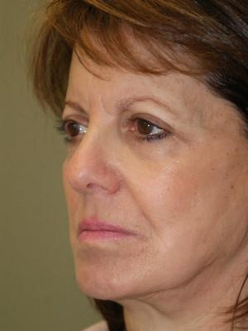 Brow Lift Before & After Gallery - Patient 392278 - Image 3