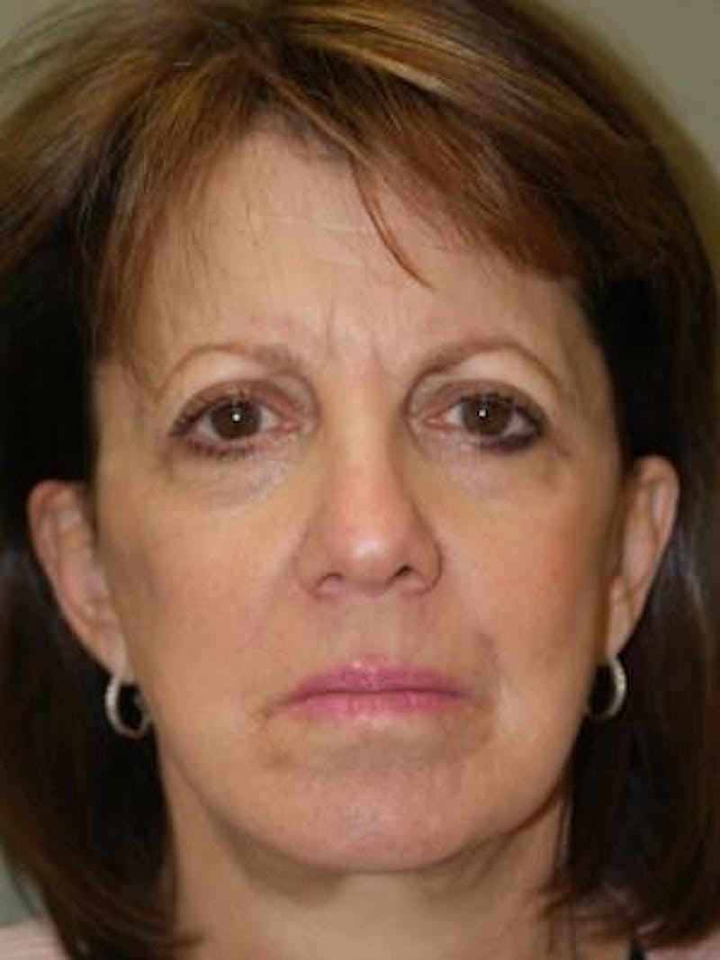 Brow Lift Before & After Gallery - Patient 392278 - Image 1