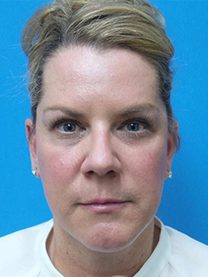 Facelift Before & After Gallery - Patient 515823 - Image 2