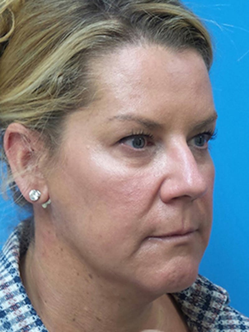 Facelift Before & After Gallery - Patient 515823 - Image 3