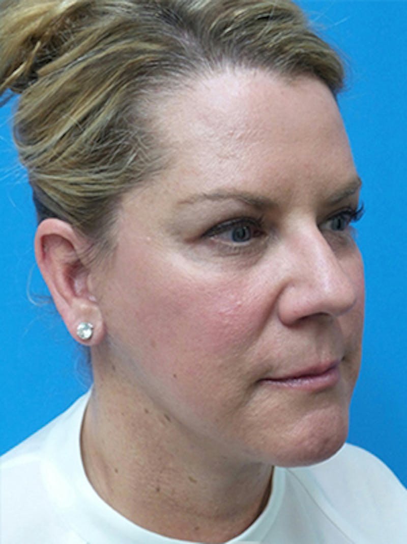 Facelift Before & After Gallery - Patient 515823 - Image 4