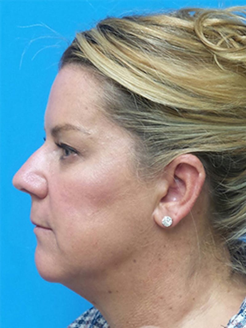 Facelift Before & After Gallery - Patient 515823 - Image 5