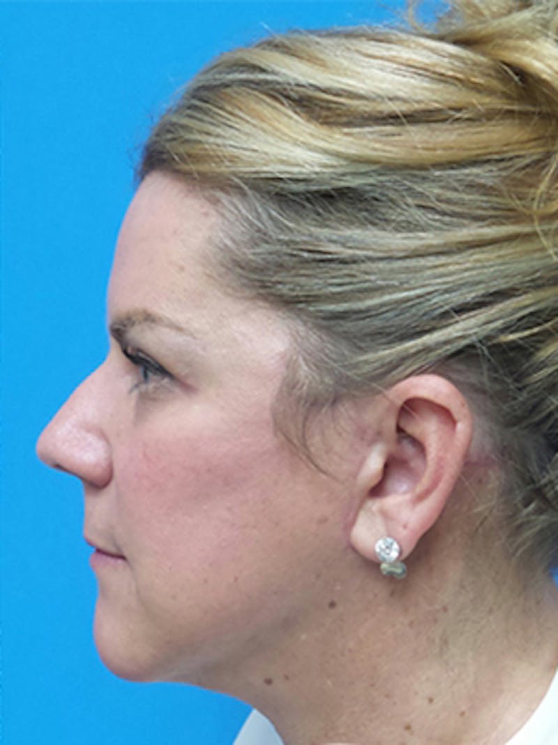 Facelift Before & After Gallery - Patient 515823 - Image 6